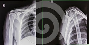 X-rayÃ¢â¬â¹ image, shoulder APÃ¢â¬â¹ and Transcapula view, photo